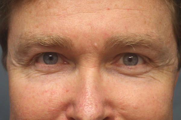 Blepharoplasty before and after - after