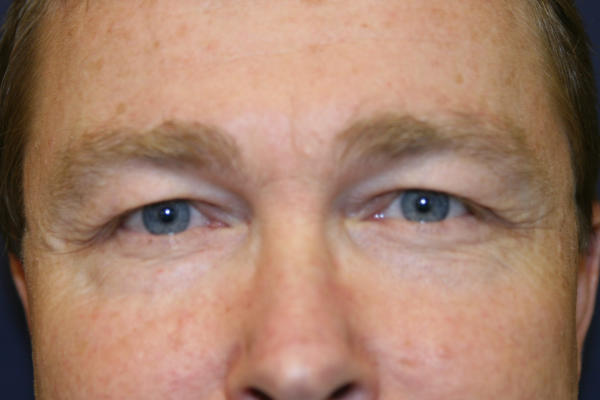 Blepharoplasty before and after - before