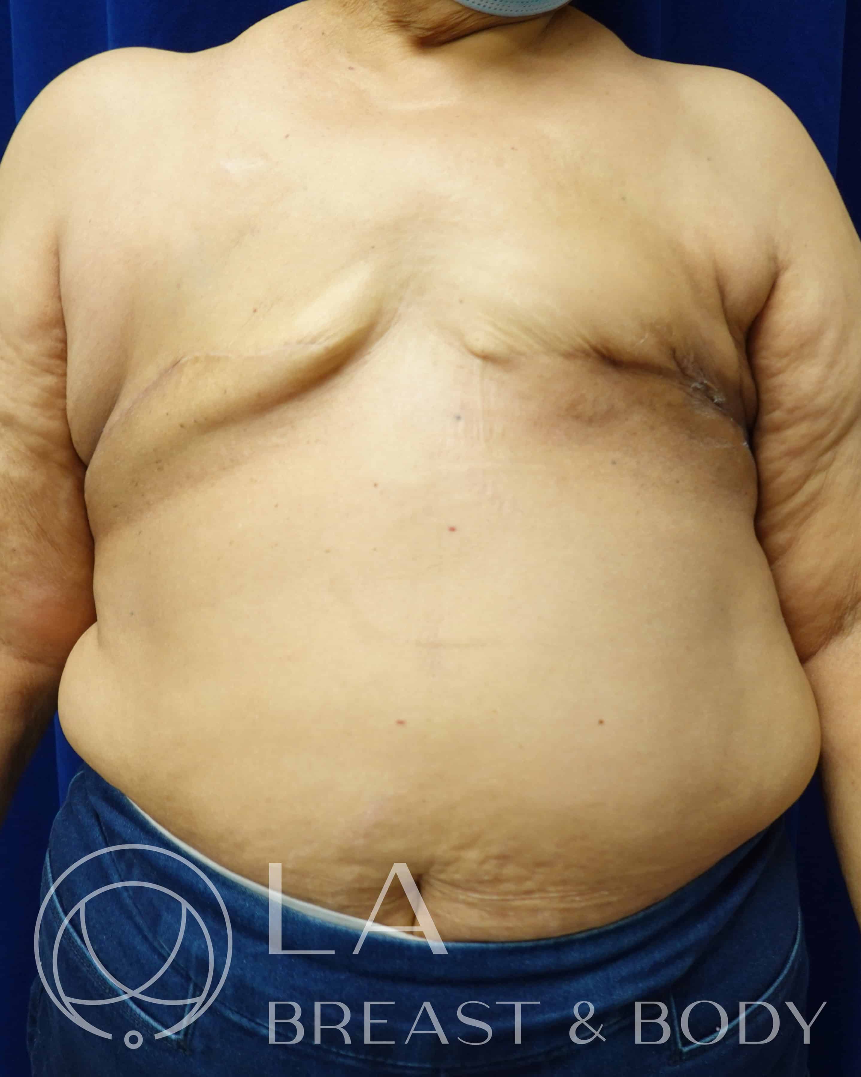 Procedure before and after - after