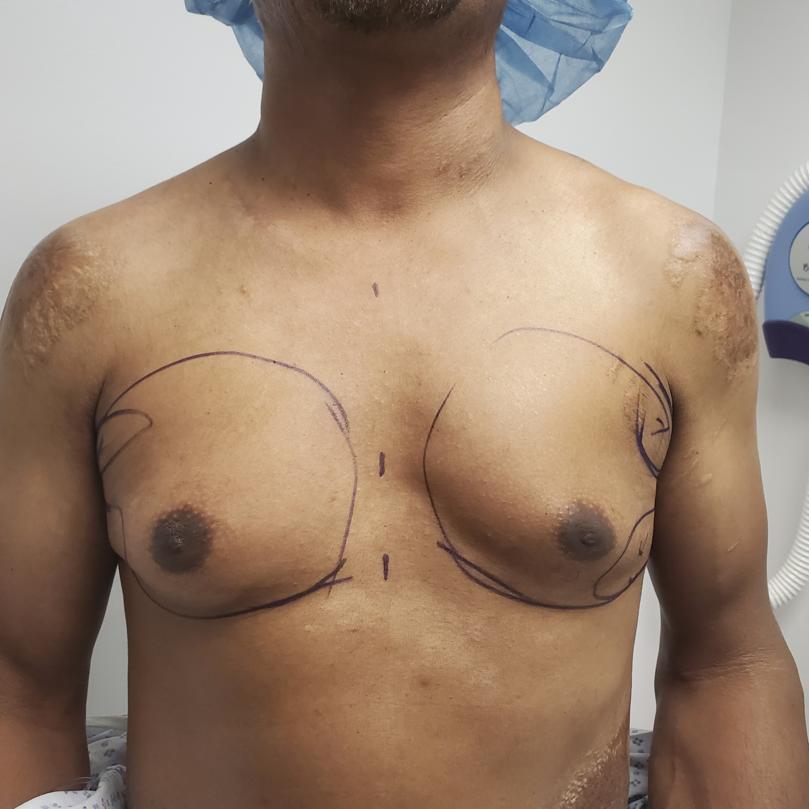 Gynecomastia Surgery before — Dr. Marc Elkowitz