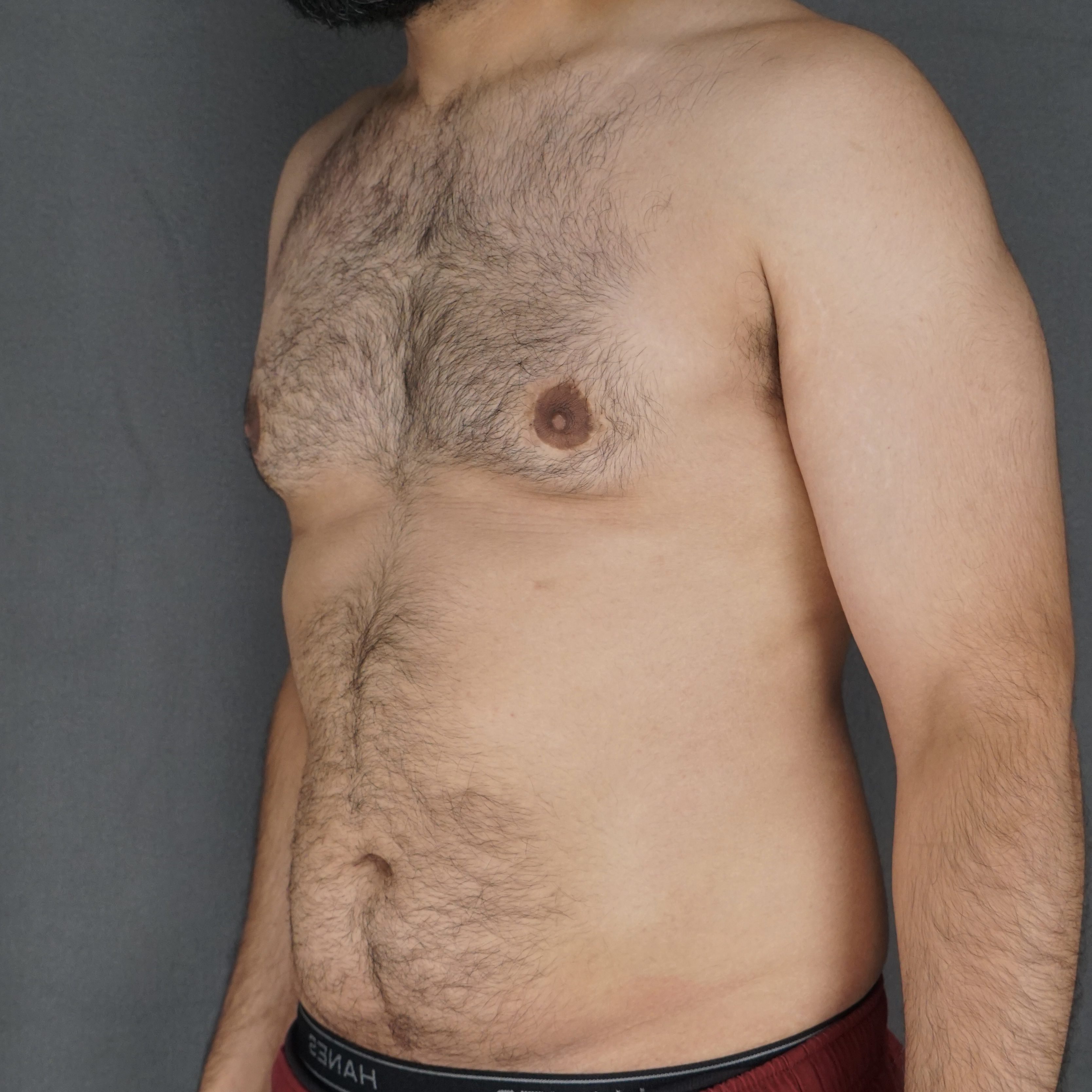 Gynecomastia Surgery after — Dr. Marc Elkowitz