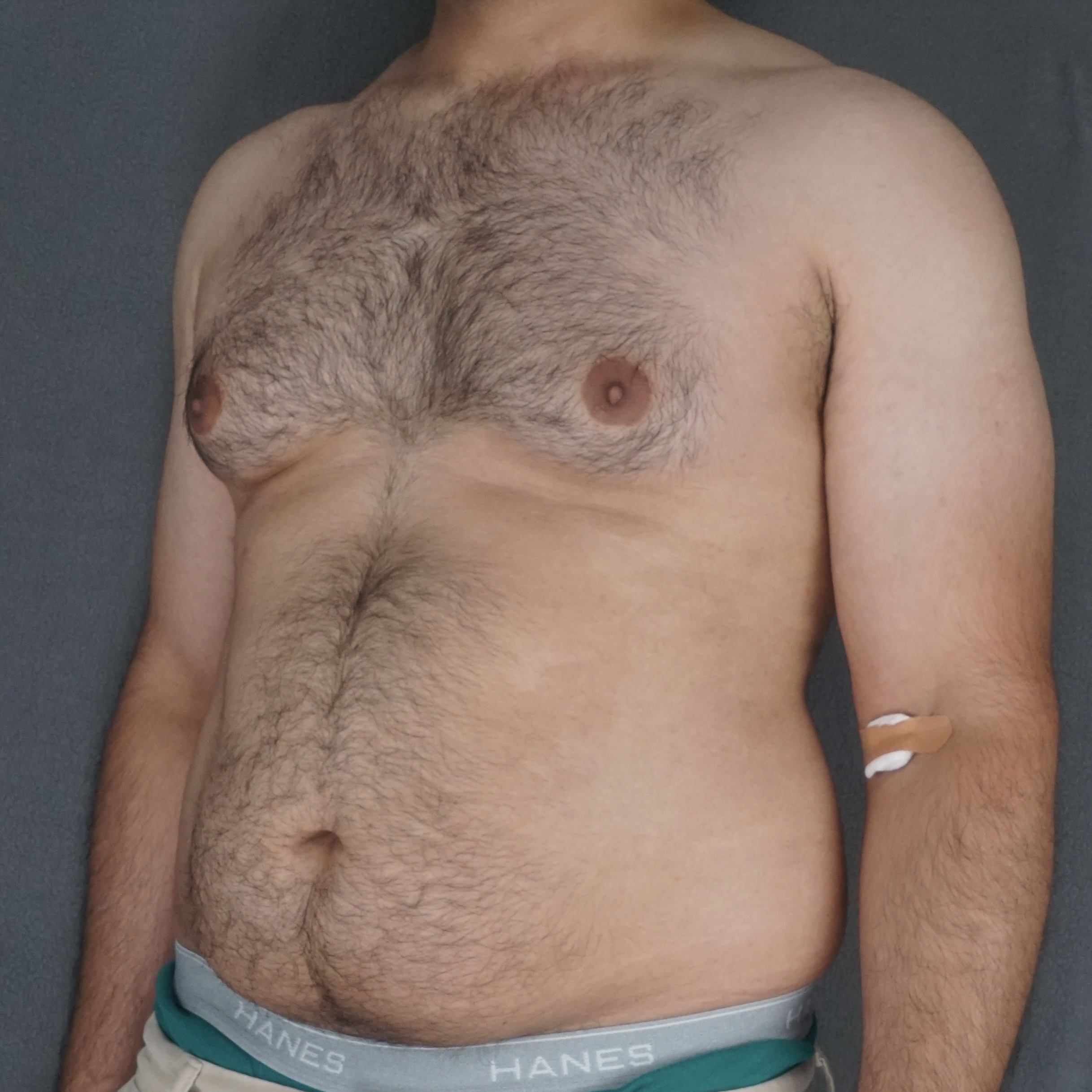 Gynecomastia Surgery before — Dr. Marc Elkowitz