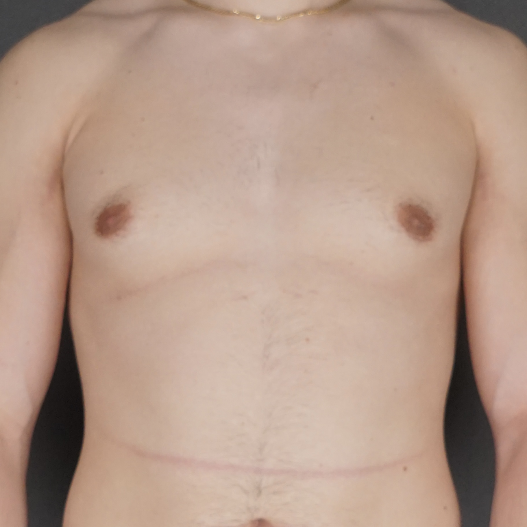 Gynecomastia Surgery after — Dr. Marc Elkowitz