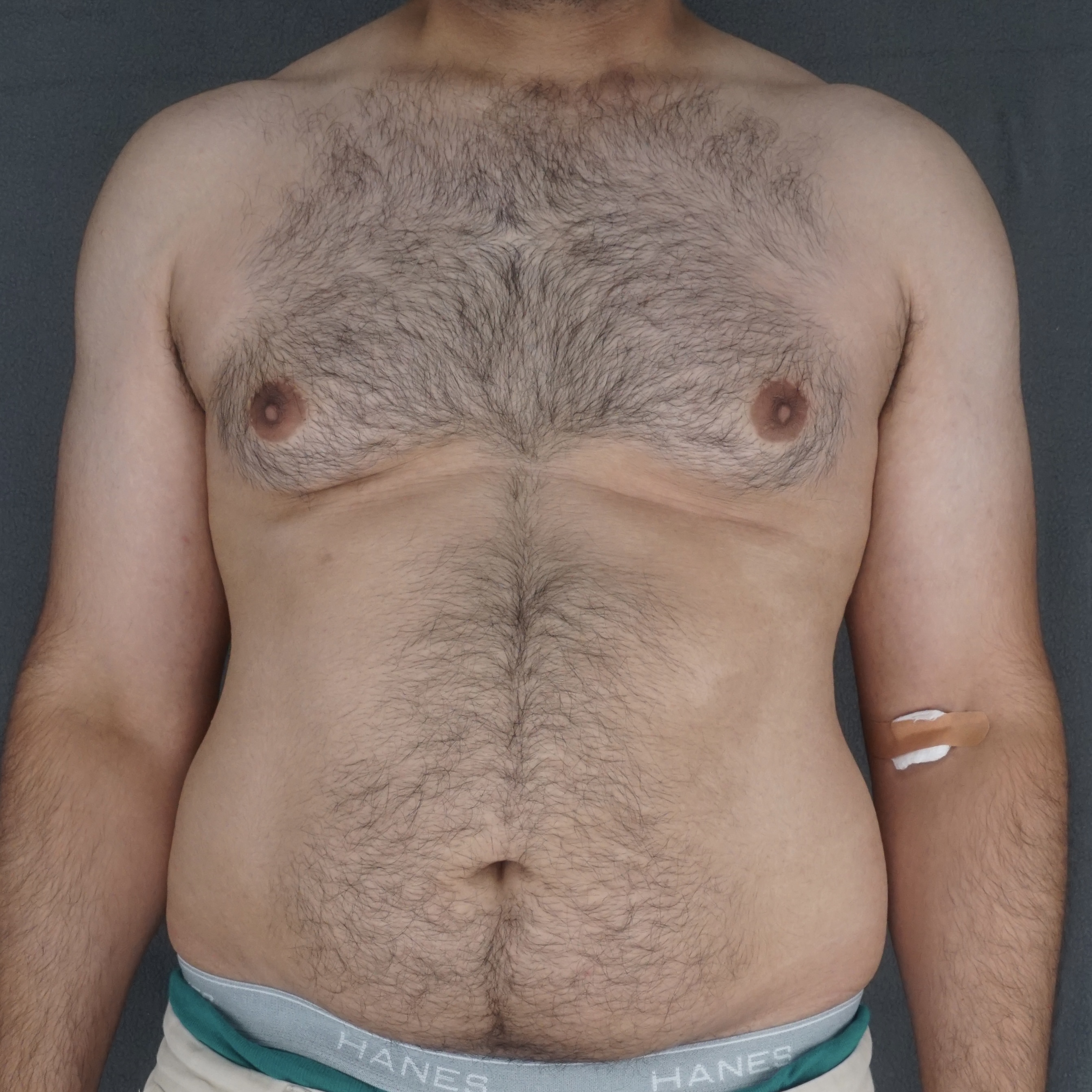 Gynecomastia Surgery before — Dr. Marc Elkowitz