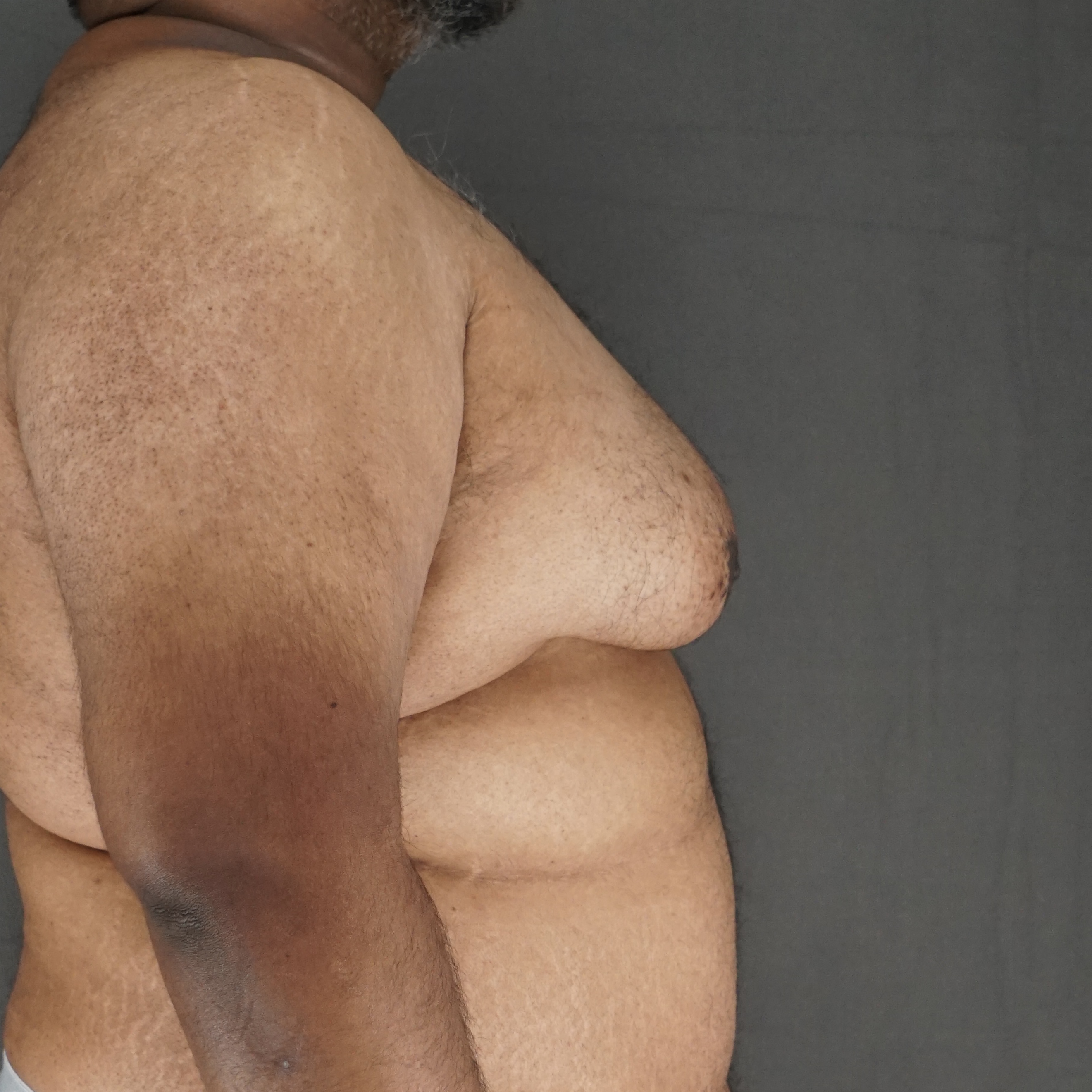 Gynecomastia Surgery before — Dr. Marc Elkowitz