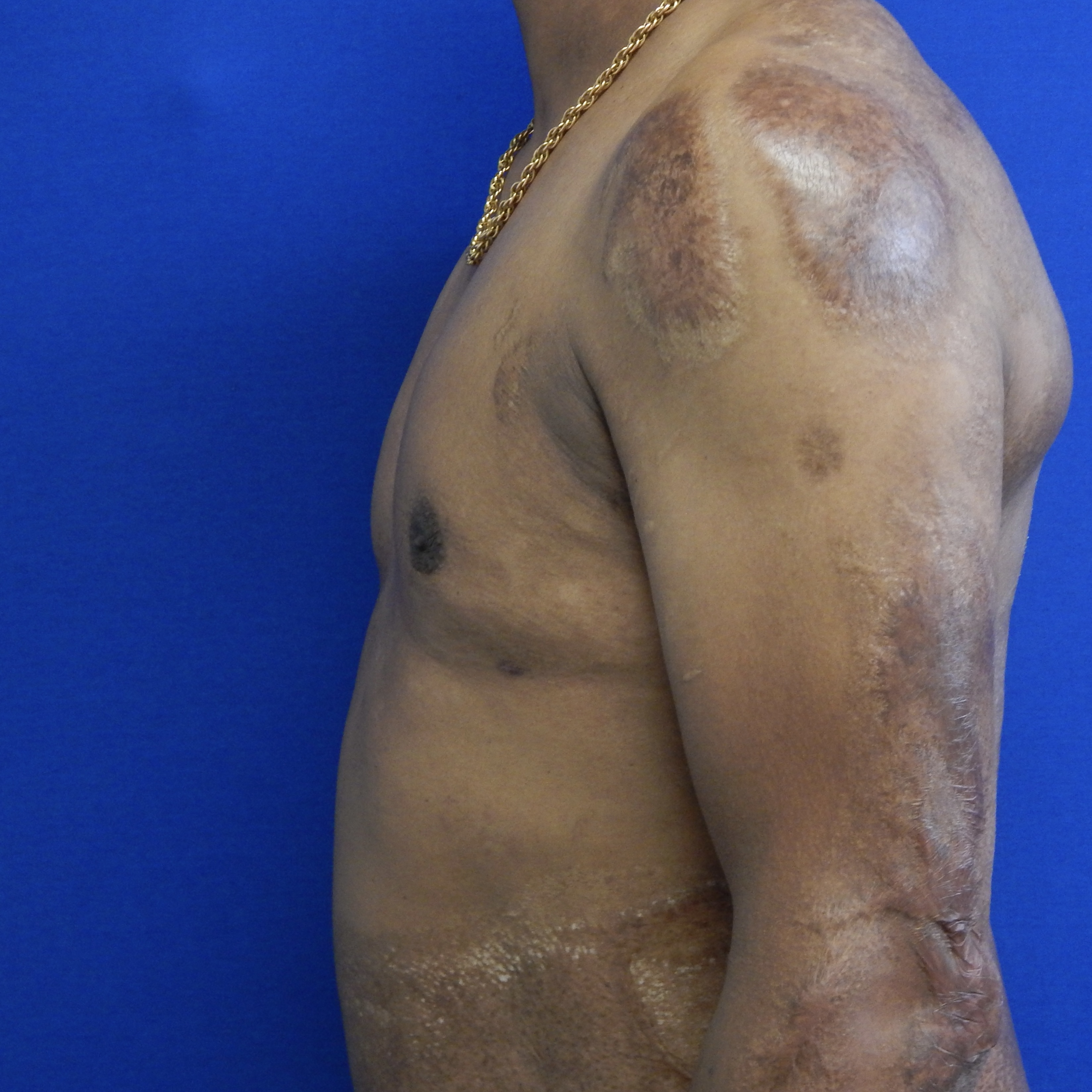 Gynecomastia Surgery after — Dr. Marc Elkowitz
