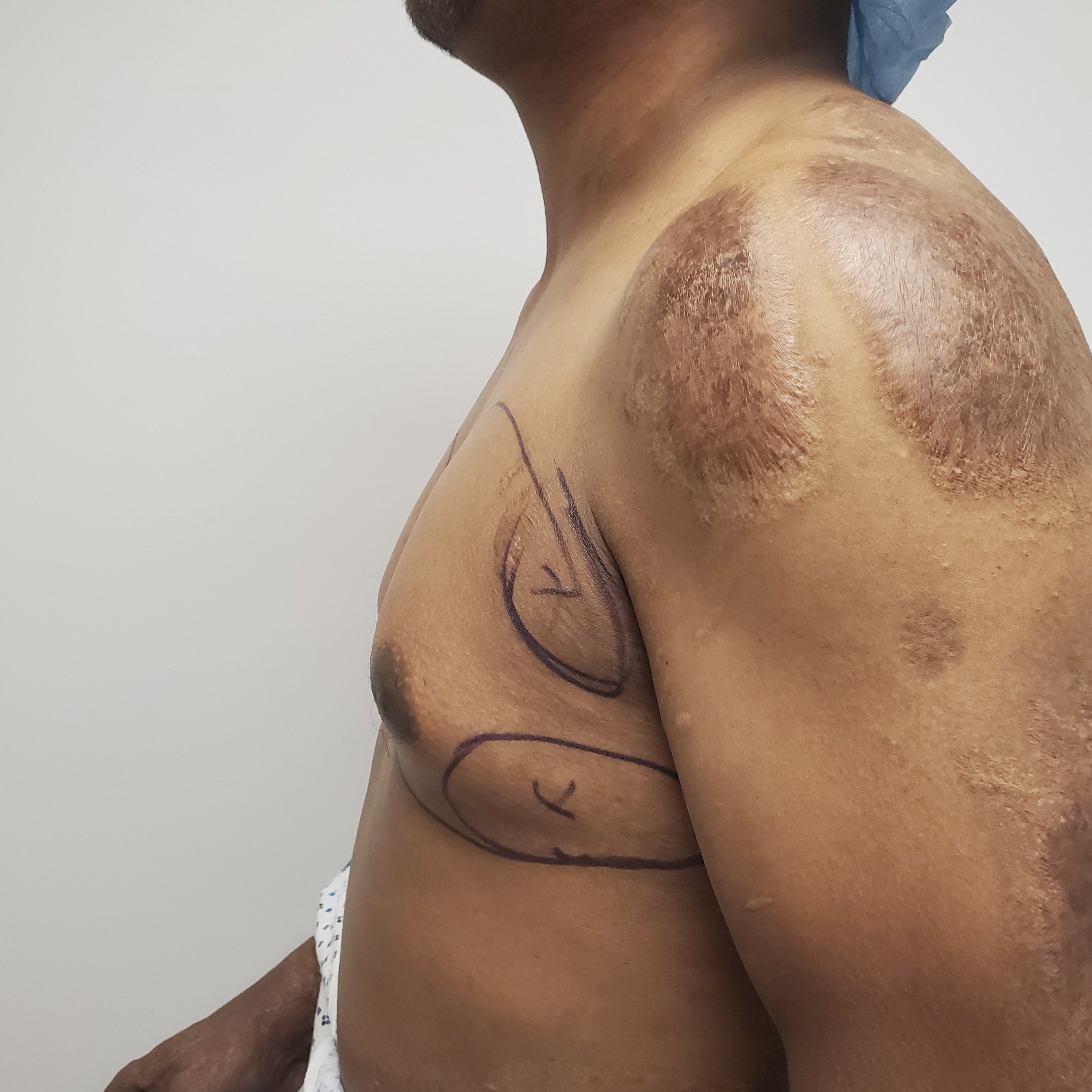 Gynecomastia Surgery before — Dr. Marc Elkowitz