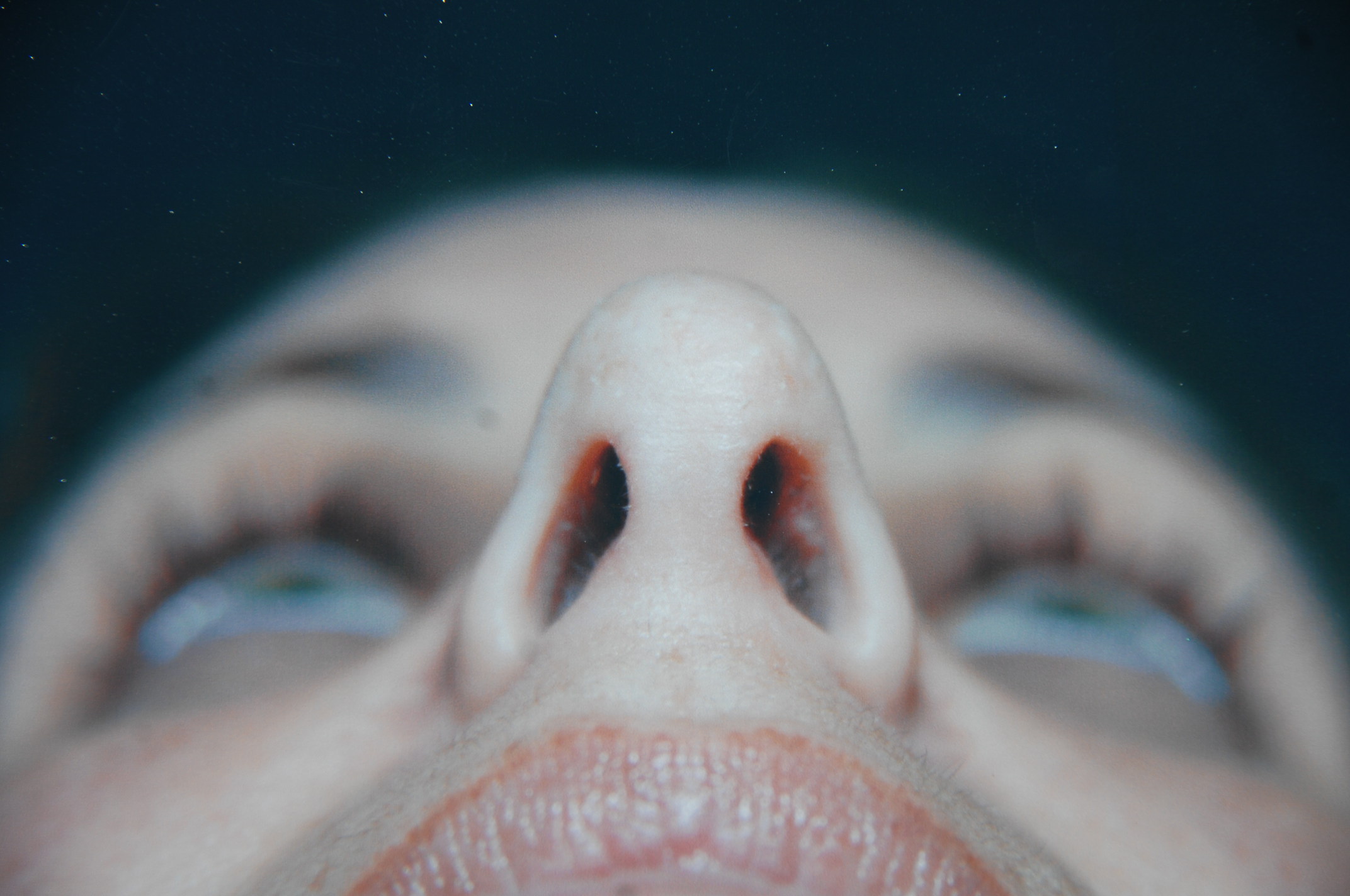 Rhinoplasty before and after - after