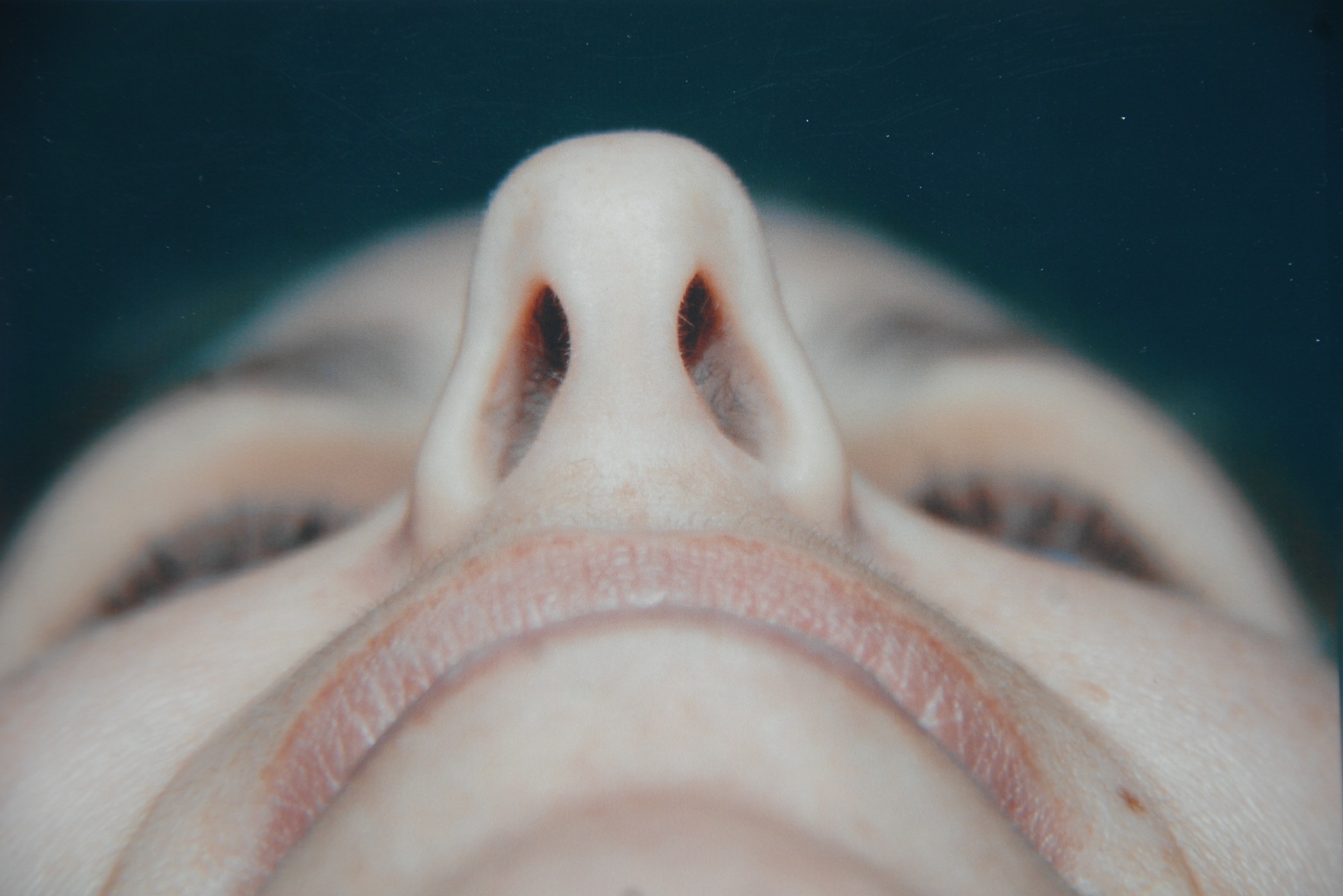 Rhinoplasty before and after - before