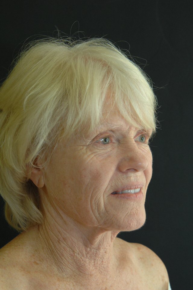 Facelift before and after - before