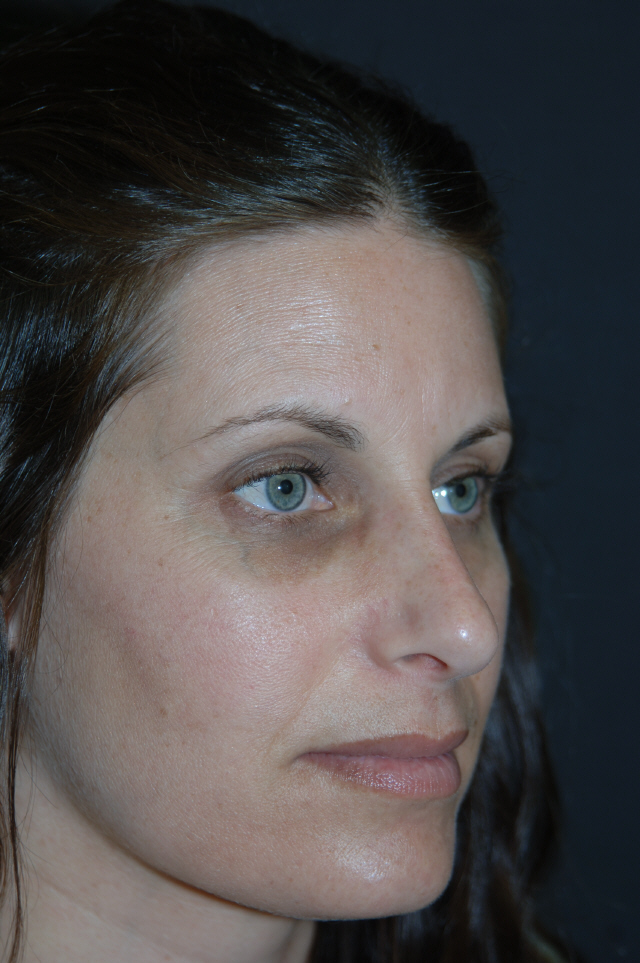 Rhinoplasty before and after - after