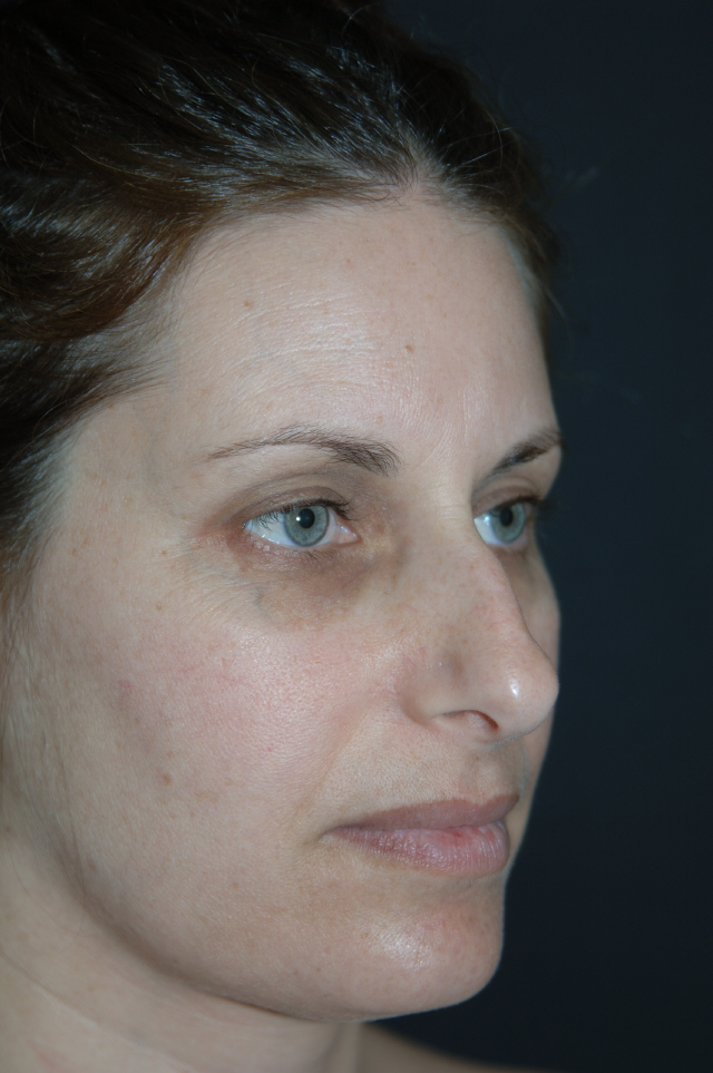 Rhinoplasty before and after - before