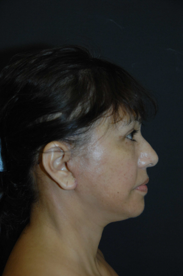Facelift before and after - after