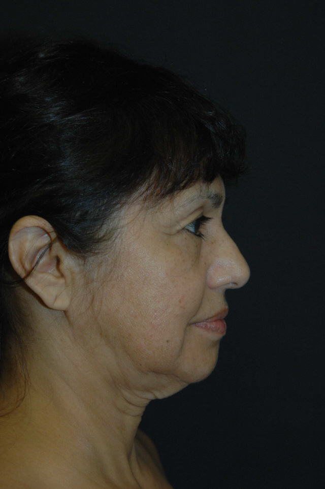Facelift before and after - before