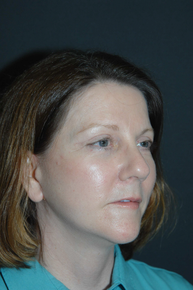 Facelift before and after - after