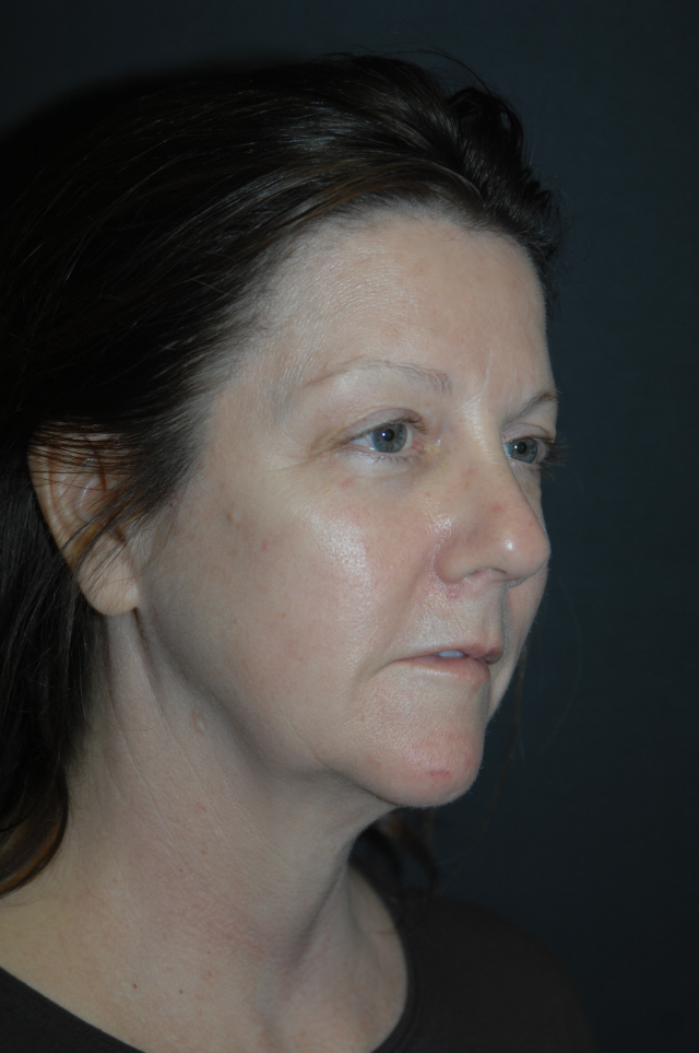 Facelift before and after - before