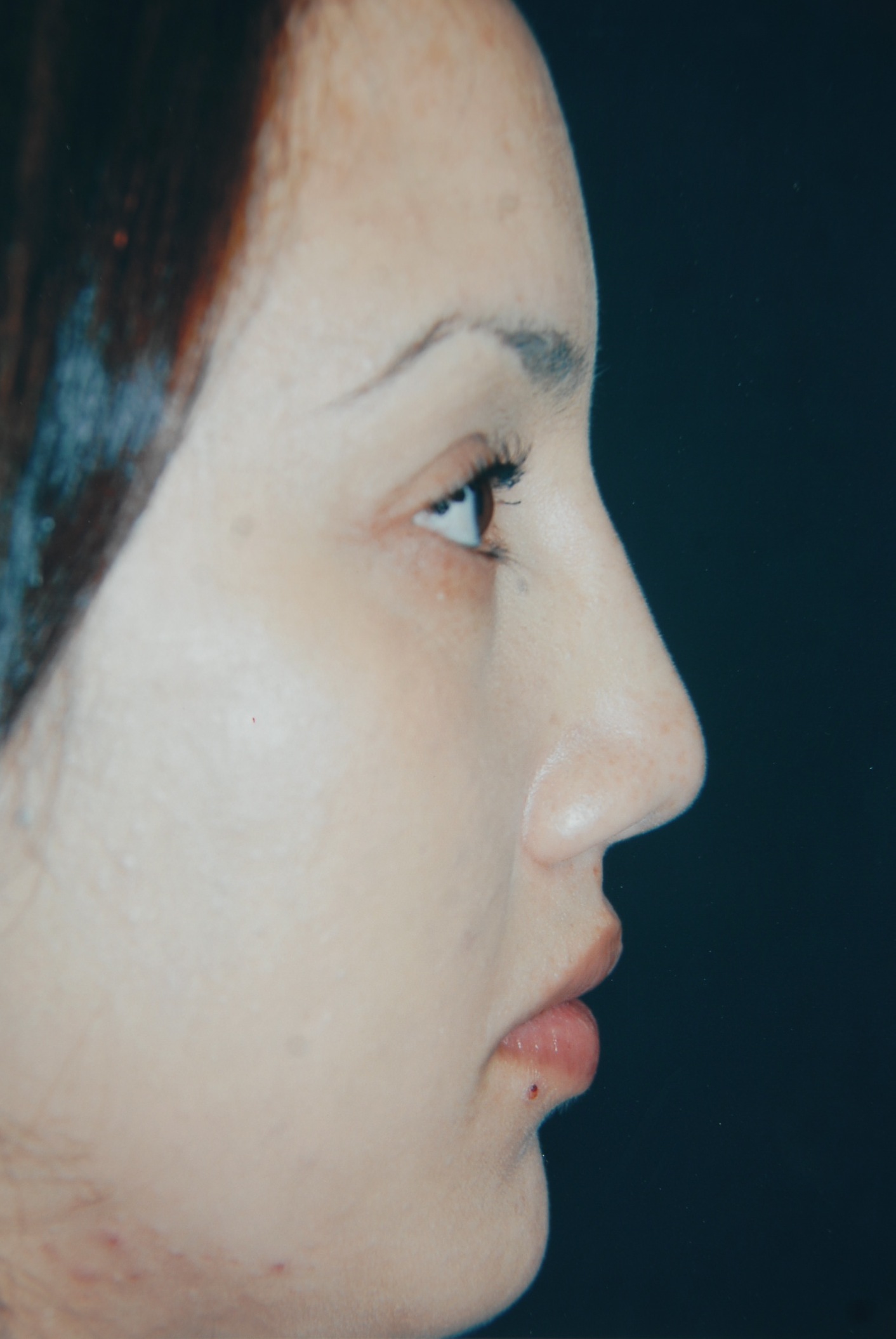 Rhinoplasty after — Dr. Lorne Rosenfield
