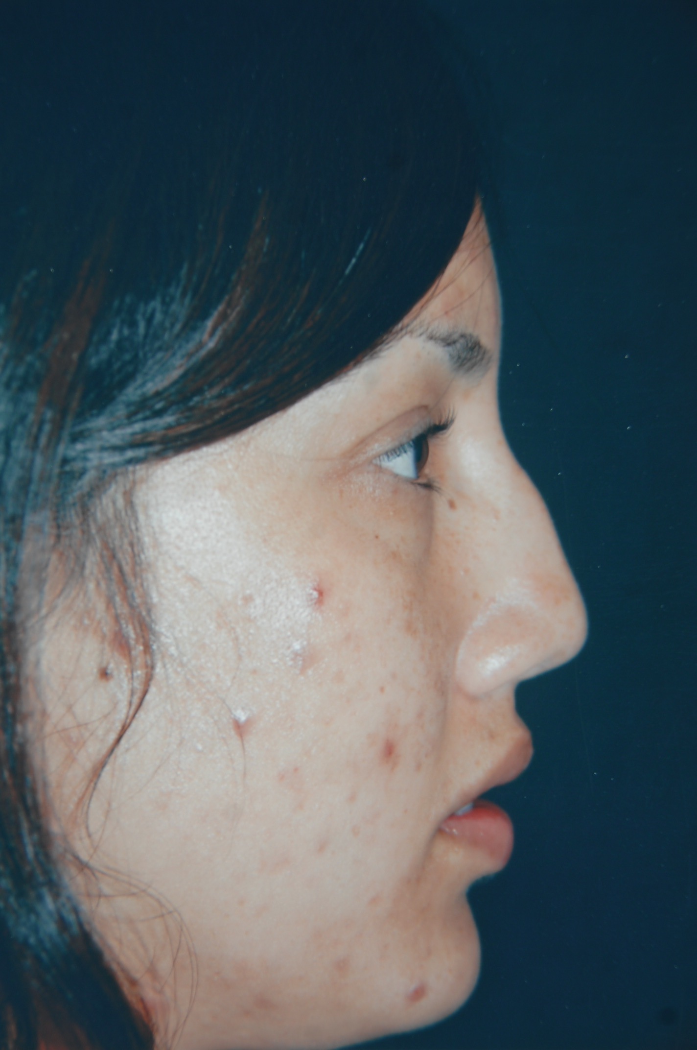 Rhinoplasty before — Dr. Lorne Rosenfield