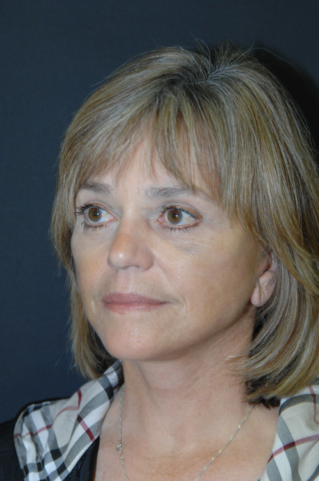 Facelift after — Dr. Lorne Rosenfield
