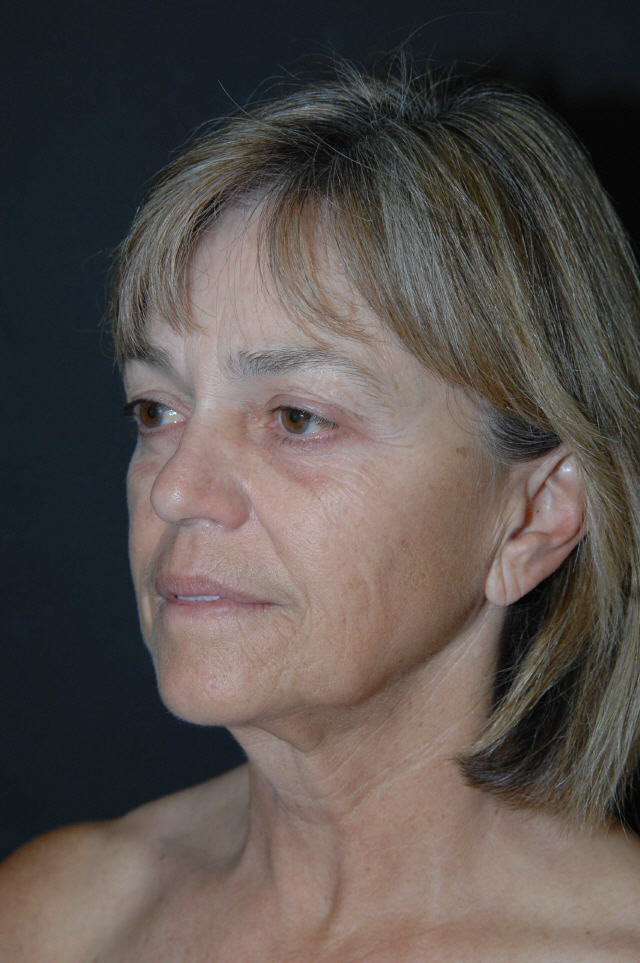 Facelift before — Dr. Lorne Rosenfield
