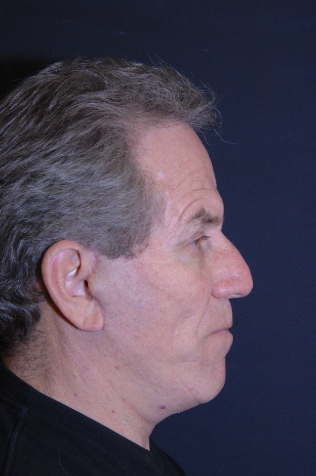 Facelift after — Dr. Lorne Rosenfield