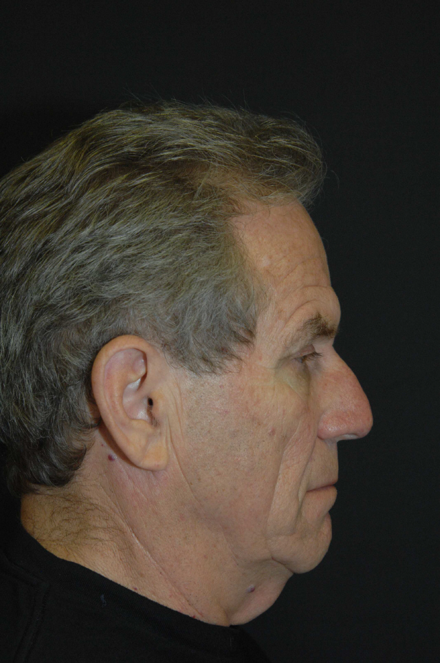 Facelift before — Dr. Lorne Rosenfield