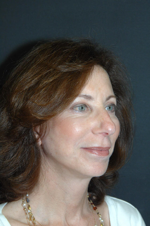 Facelift after — Dr. Lorne Rosenfield