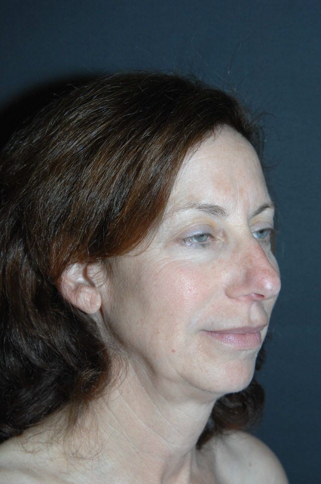 Facelift before — Dr. Lorne Rosenfield