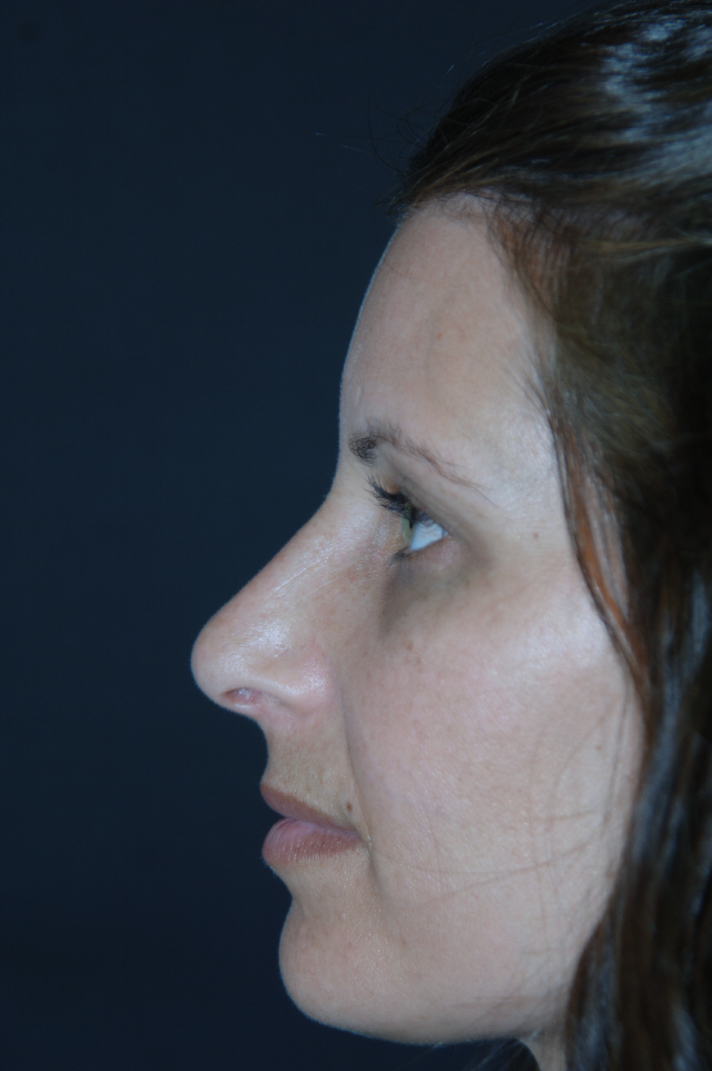 Rhinoplasty after — Dr. Lorne Rosenfield