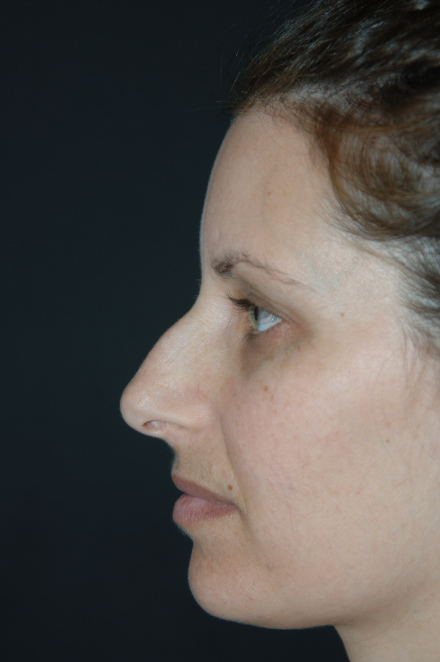 Rhinoplasty before — Dr. Lorne Rosenfield