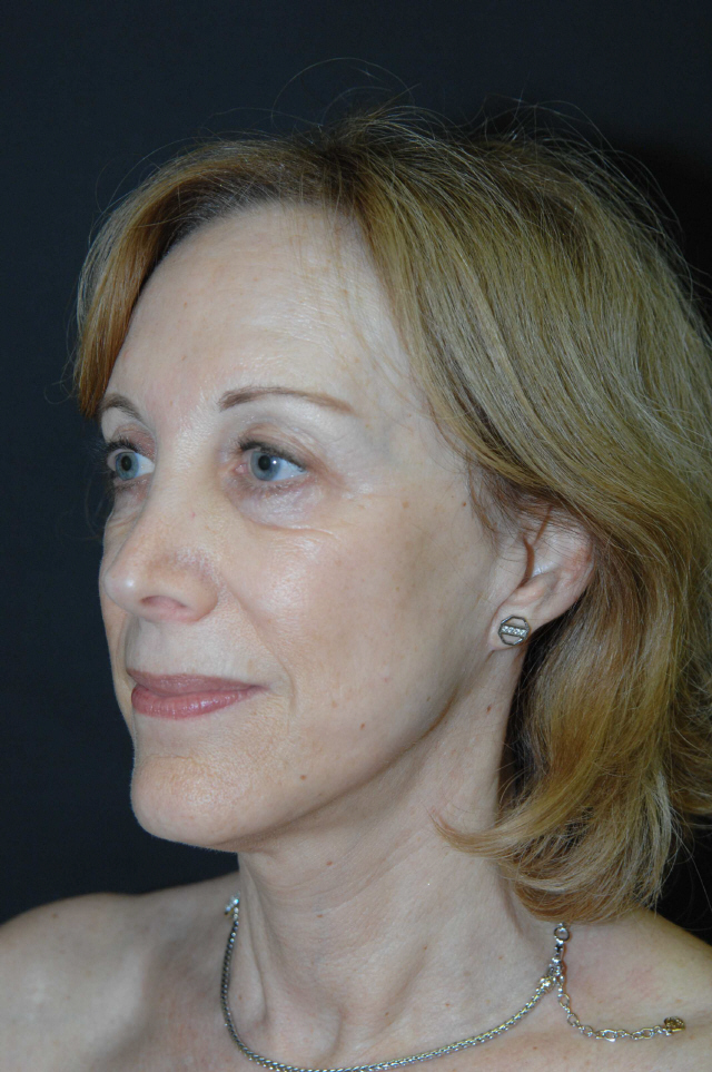 Facelift after — Dr. Lorne Rosenfield