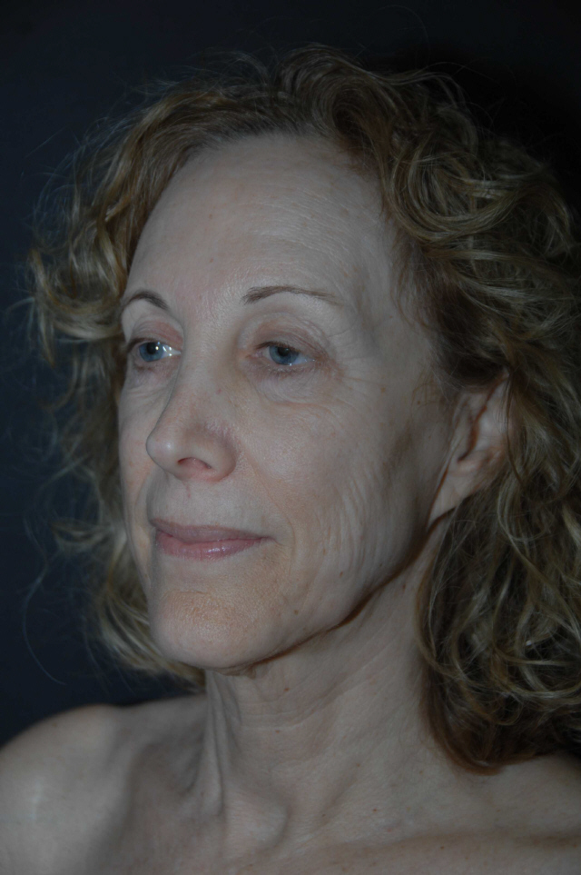 Facelift before — Dr. Lorne Rosenfield