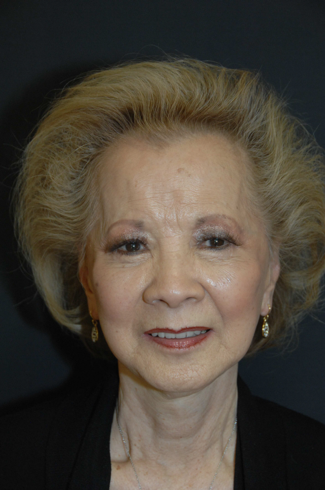 Facelift after — Dr. Lorne Rosenfield