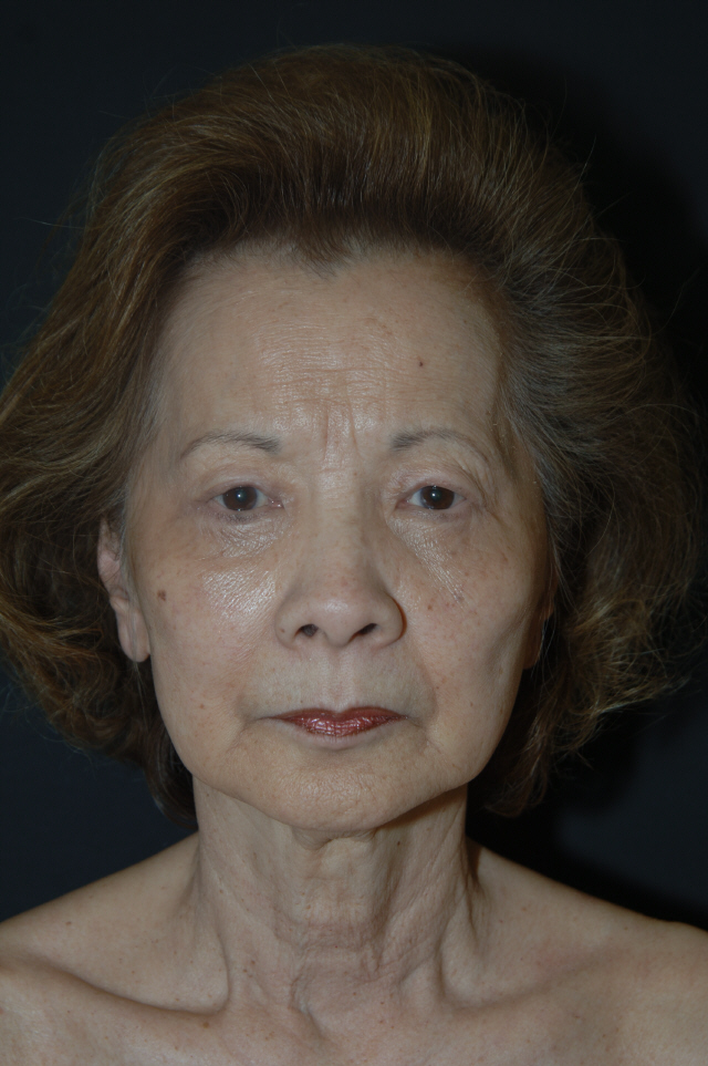 Facelift before — Dr. Lorne Rosenfield
