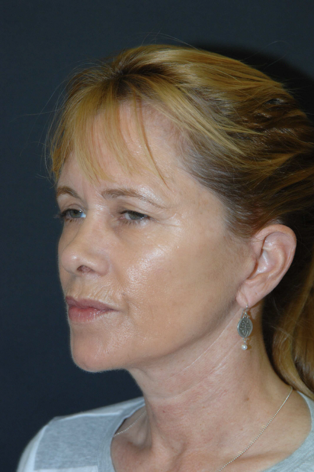 Facelift before and after - after