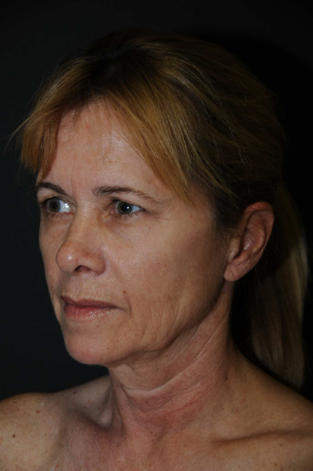 Facelift before and after - before