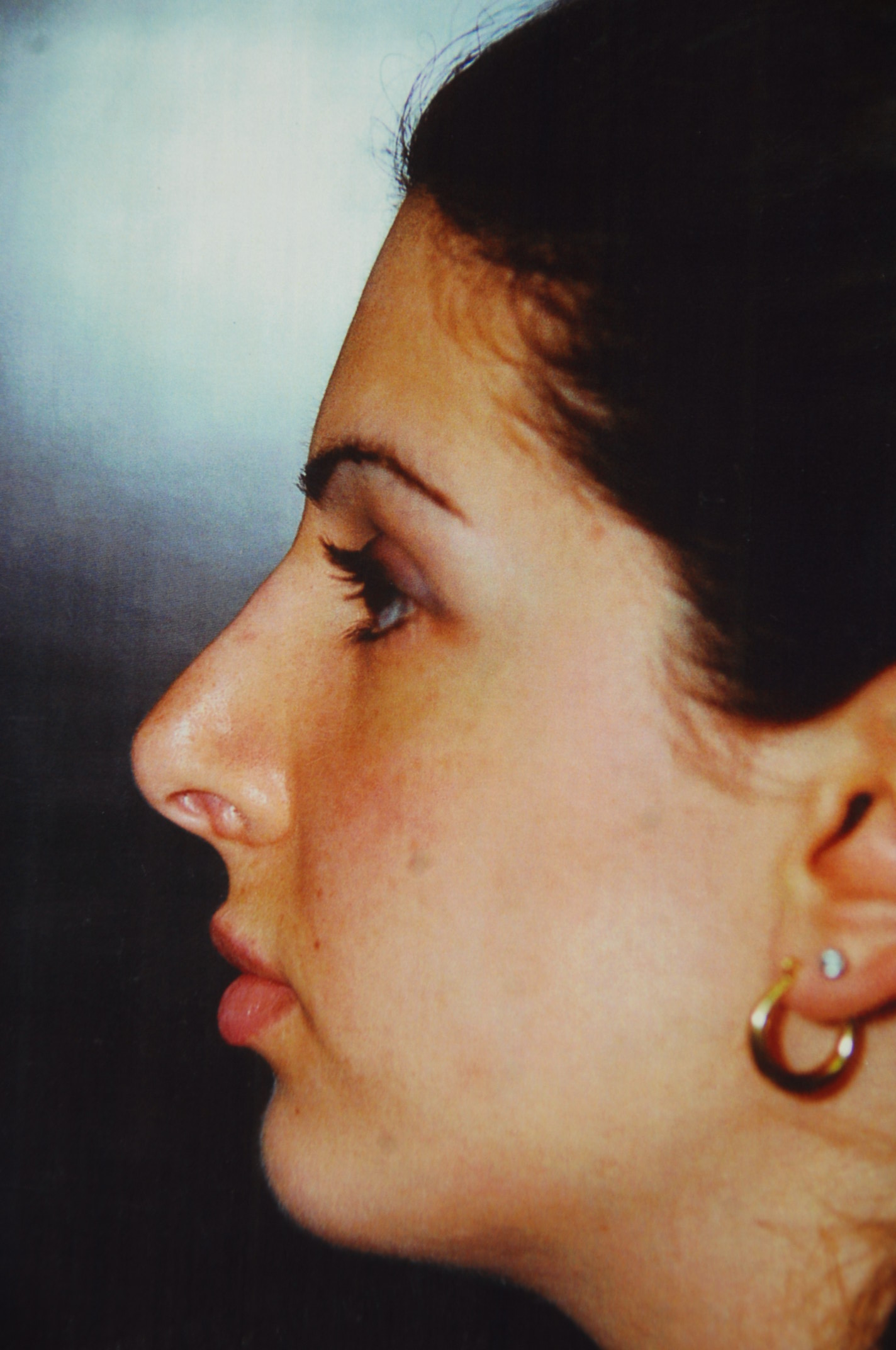 Rhinoplasty before and after - after