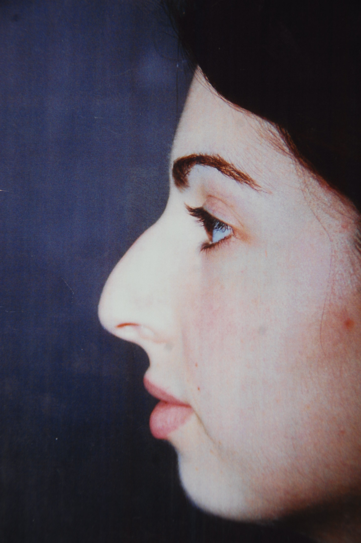 Rhinoplasty before and after - before