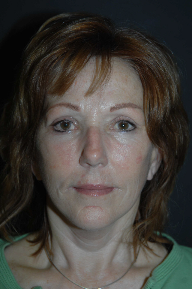 Facelift after — Dr. Lorne Rosenfield