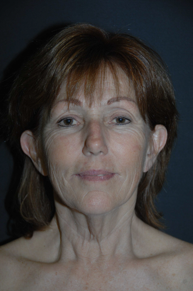 Facelift before — Dr. Lorne Rosenfield