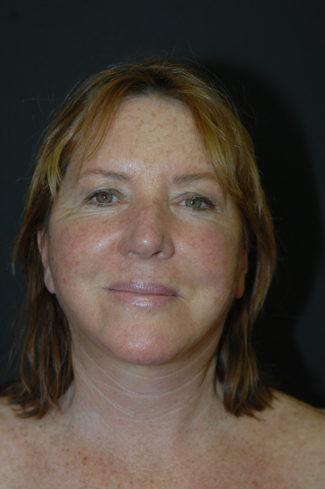 Facelift before and after - after
