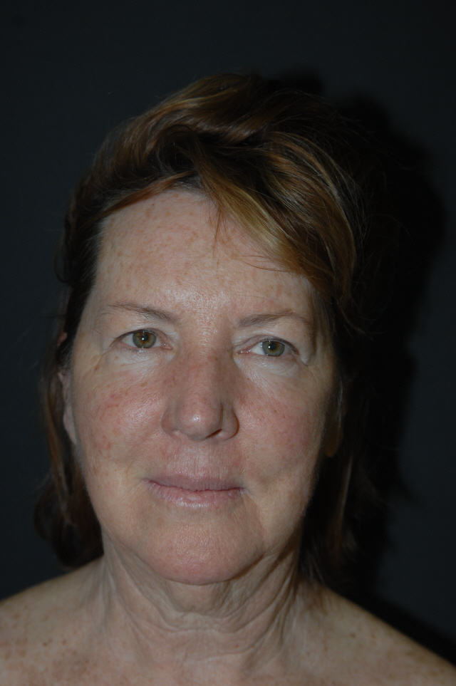 Facelift before and after - before