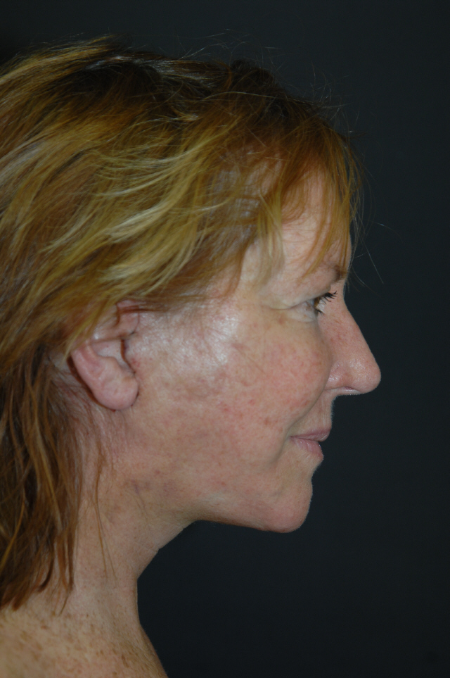 Facelift after — Dr. Lorne Rosenfield