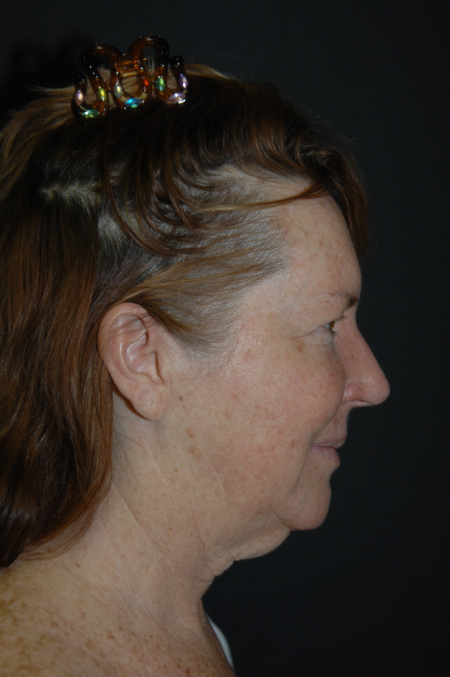 Facelift before — Dr. Lorne Rosenfield