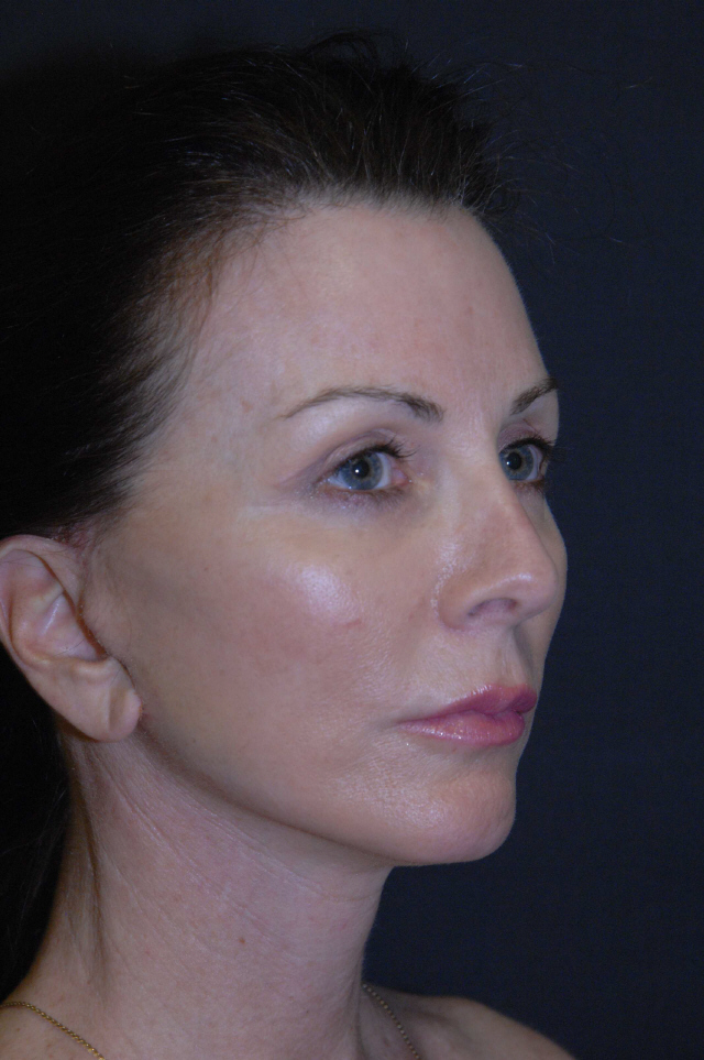 Facelift before and after - after
