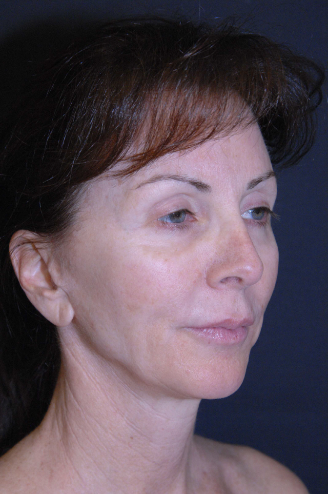 Facelift before and after - before