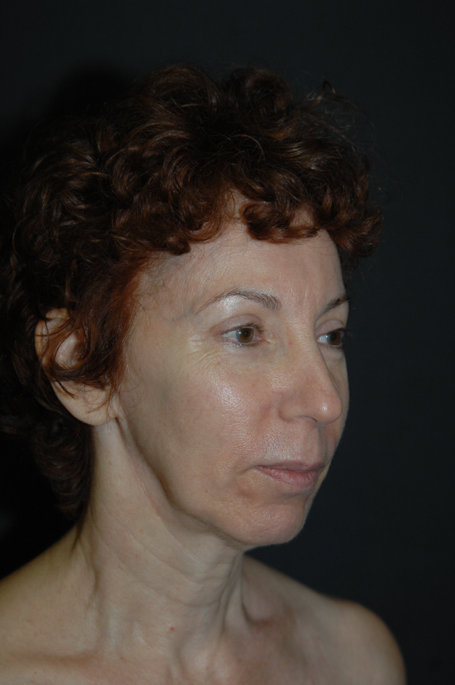 Facelift before — Dr. Lorne Rosenfield