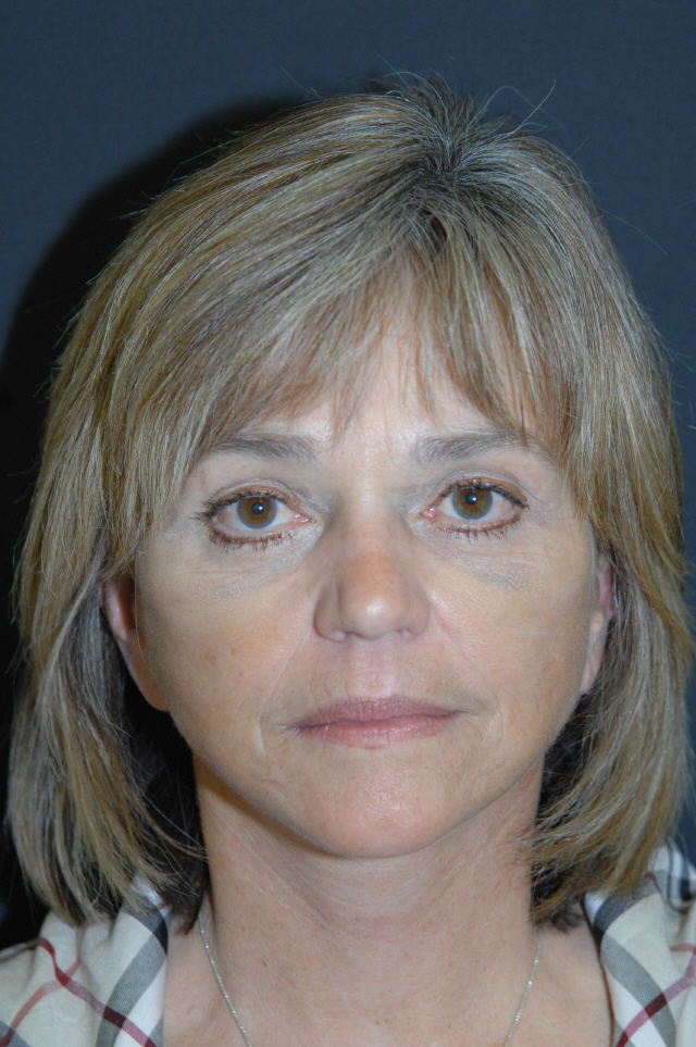 Facelift before and after - after