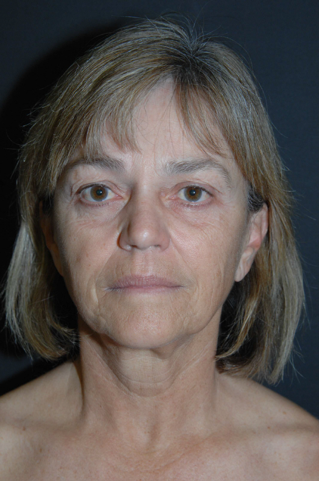 Facelift before and after - before
