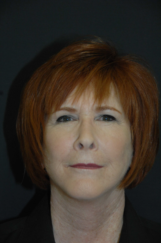 Facelift before and after - after